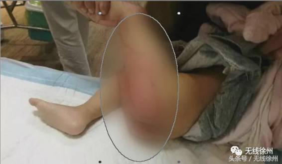 3岁女童被烧成火人！不到半个月徐州一医院已经接了4例！