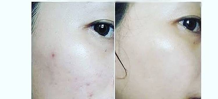 一款日本祛痘膏八百多块钱,最多销量的祛痘护肤品