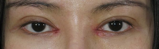 开眼角一个月还是疼,开眼角一个月还是肿需要注意什么