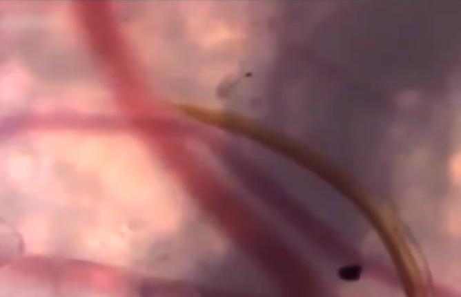 可以吸脂肪的蚊子是真的吗,蚊子抽脂肪吗