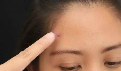 小孩最快解决痘痘的方法,长痘痘的小伙伴们看过来