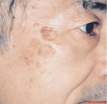 老年斑会导致雀斑吗,老年斑长大有危险吗