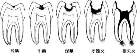 乳牙有黑块需要补吗,宝宝乳牙黄斑怎么治疗