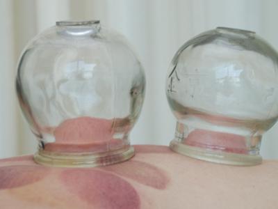 湿气重拔完火罐应该注意什么,能不能拔火罐祛湿毒