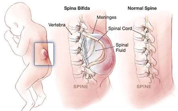 隐性脊柱裂怎么治疗最好,骶1隐性脊柱裂如何治疗
