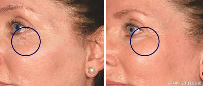 眼周很多小颗粒怎么办,眼周起斑点是什么原因