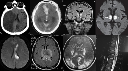 中枢神经脱髓鞘病是重大疾病吗,中枢神经系统脱髓鞘和多发性硬化