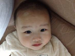 婴幼儿也会得白癜风？是因为遗传吗？