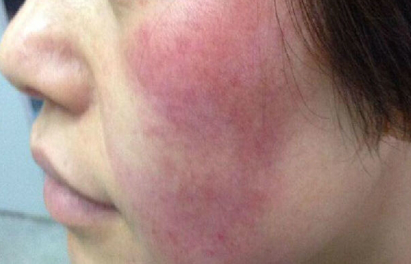 脸上有红血丝怎么办最有效的方法,脸上有红血丝怎么修复小窍门