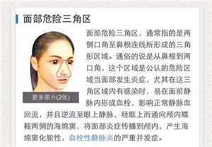 长痘痘如何正确挤,长痘痘怎么挤爆