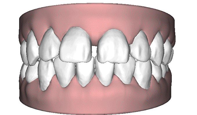 门下门牙有缝隙怎么补救,门牙开缝怎么处理最好