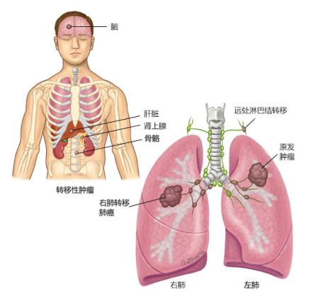 关于癌症你一定要知道的事,肺癌家属应该知道哪些问题