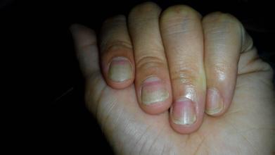 神经性皮炎变厚怎样恢复正常,神经性皮炎皮肤增厚是什么原因