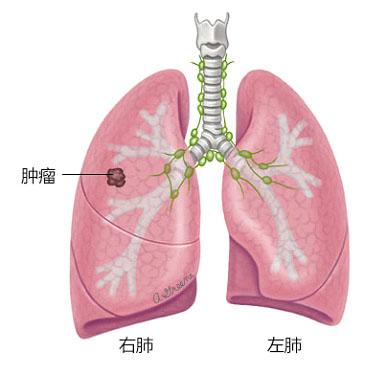 关于癌症你一定要知道的事,肺癌家属应该知道哪些问题