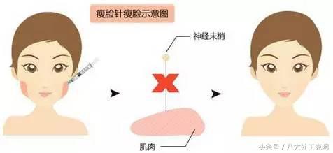 瘦脸针三次真的能定型吗,瘦脸针打三次就可以永久定型了吗