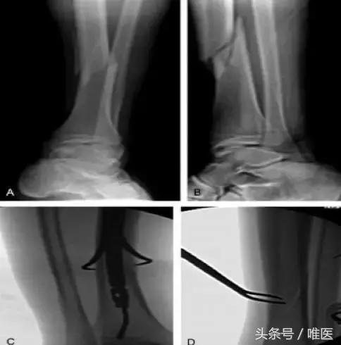 胫骨远端骨折怎样促进愈合,胫骨外侧骨折怎么处理