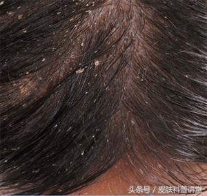 头皮屑多且脂溢性皮炎,头皮屑多头痒脂溢性皮炎