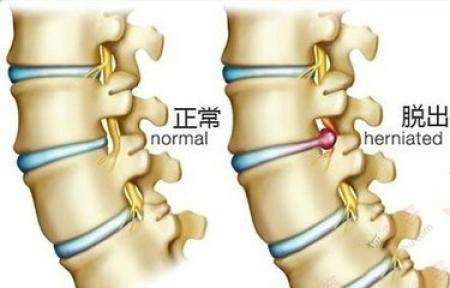 腰椎生理曲度变直吃什么药,颈椎间盘曲度变直