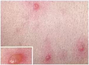 春风一吹身上起小疙瘩,春风吹的脸上起小疙瘩