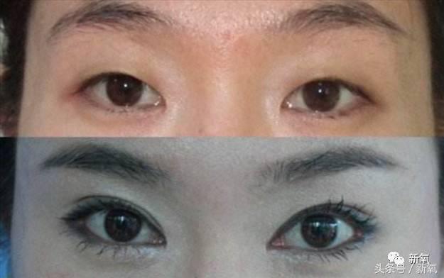 为什么开眼角会变漂亮,为什么开眼角很奇怪