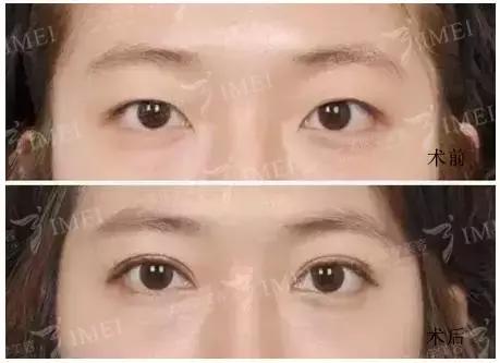 割一个双眼皮去哪做修复,修复3000块的双眼皮你敢做吗