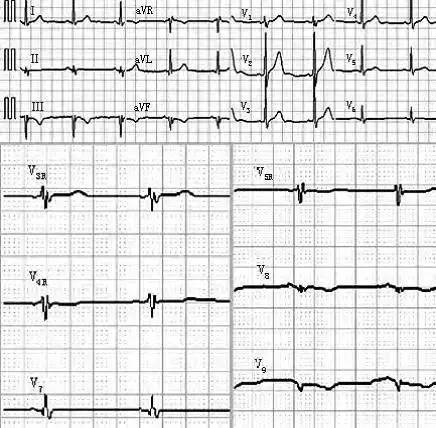 一分钟阅读心电图,心电图阅读讲解