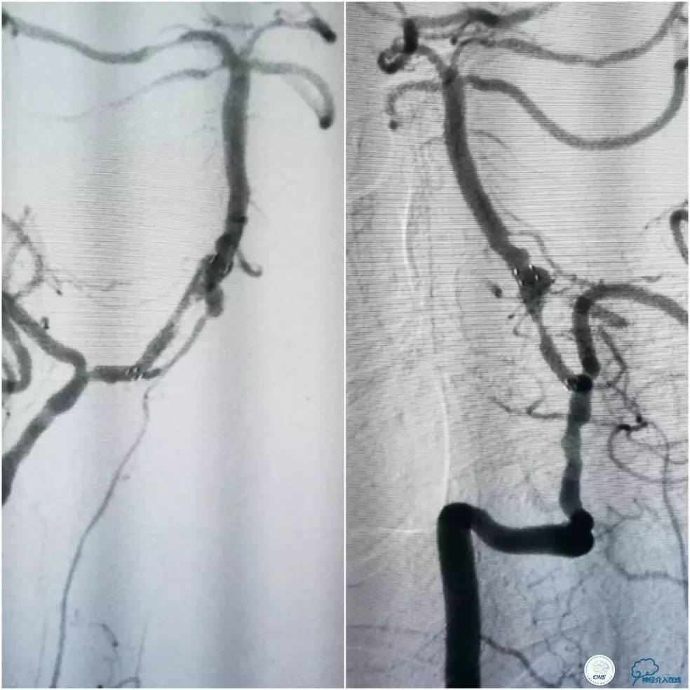 天坛周记|右椎动脉V1段及V4-基底动脉串联病变支架治疗一例