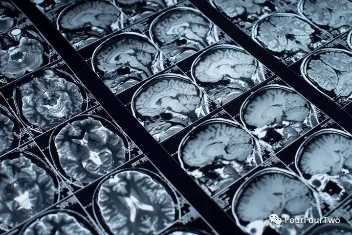 头球会伤头部吗,头球影响球员大脑或致记忆衰退