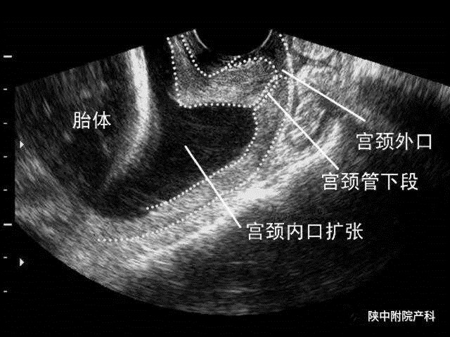 为什么一直有宫缩然后流产,没有宫缩也能生宝宝吗