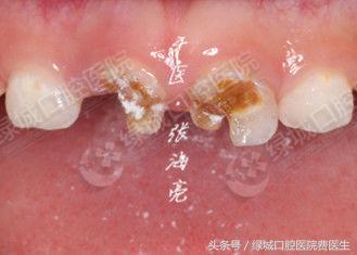 乳前牙透明冠修复大概要多久,乳前牙透明冠操作流程