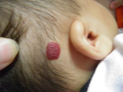 小孩身上有红斑是不是血管瘤,婴儿面部红斑痣与血管瘤怎么判断