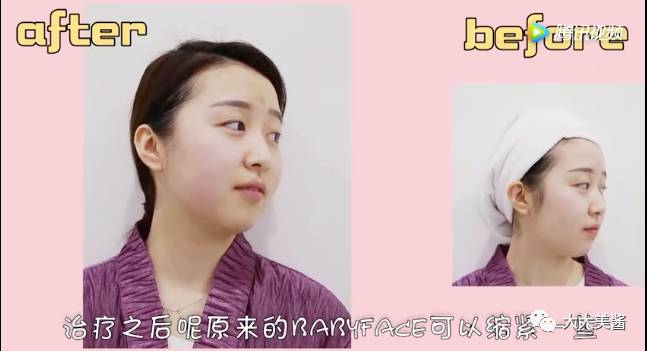 视频｜还没到30，皮肤松弛了？不开刀也不疼的射频提升？