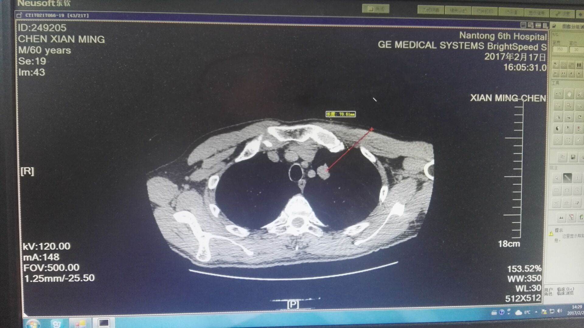 南通肺结节微创手术费用,合肥治肺癌的消融术