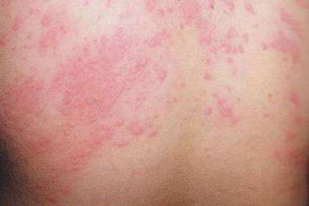 过敏体质者应该怎么来改善