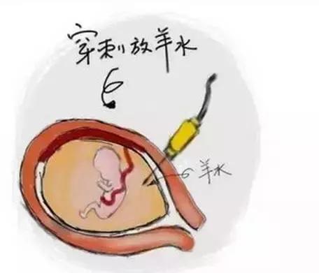 育儿宝典羊水胎心,怎么避免羊水过多或过少