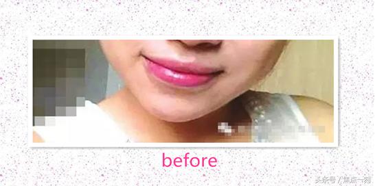 垫下巴之后感觉嘴扁,垫下巴垫歪了能用玻尿酸矫正吗