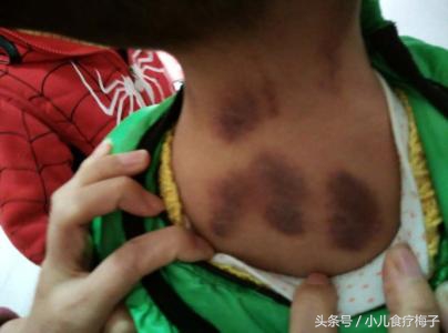 持续高烧39度吃药不退怎么办,39度一直高烧不退退烧药无效