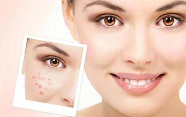 最近脸上疯狂长痘是因为换季吗,一换季脸就起痘