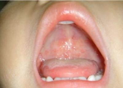 柯萨奇病毒怕不怕热,柯萨奇病毒又称为手足口对不对