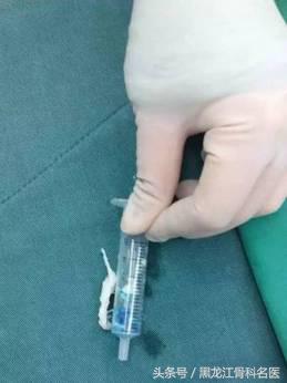 病例分享丨微创疗法让老人远离“腰突”困扰