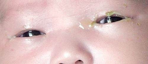 宝宝有眼屎多且黄还粘稠是上火吗,宝宝眼屎又黄又多怎么回事