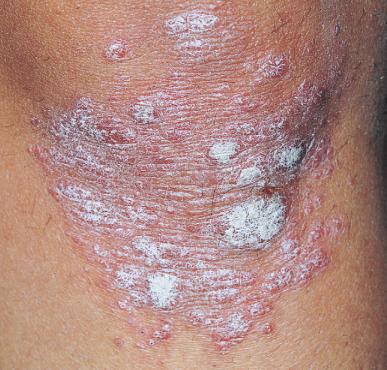 银屑病关节炎和银屑病区别,银屑病关节炎跟银屑病一样吗