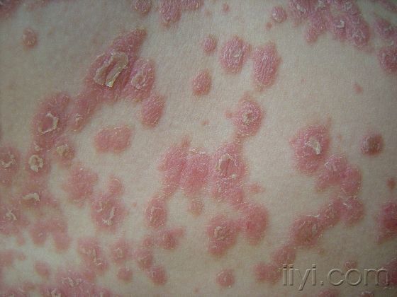 皮肤型红斑狼疮用什么药膏,皮肤型红斑狼疮的饮食