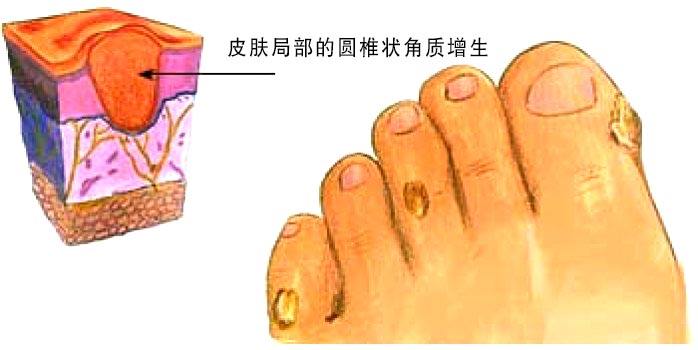 认识指甲死皮,认识足字旁