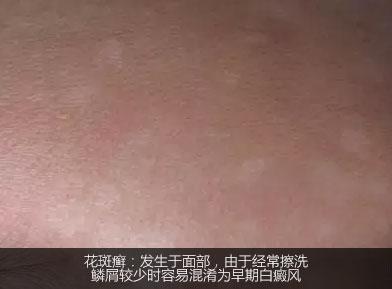不是白癜风的白斑能查出是什么吗,不是白癜风的白点是啥