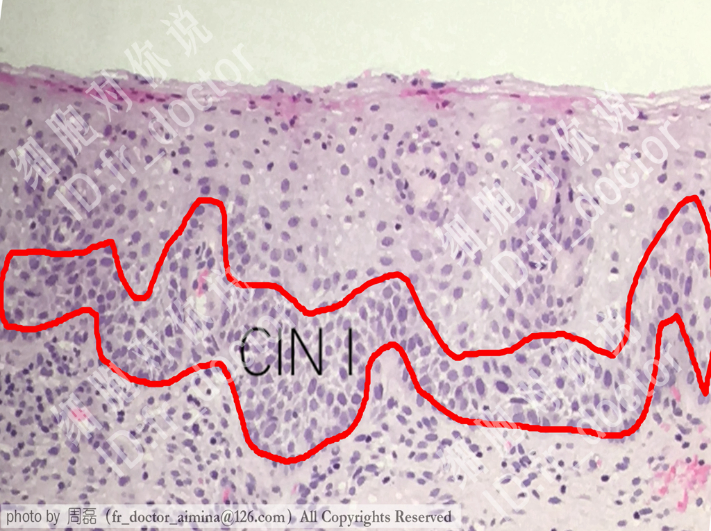 宫颈高度病变镜下观察,宫颈镜下可疑浸润癌严重吗