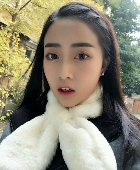 下巴后缩垫下巴案例,垫了下巴膨体皮肤松弛严重