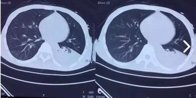 奇迹！跨越600公里疾速异地协作百草枯中毒患者起死回生