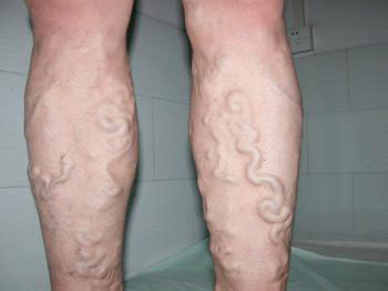 静脉曲张怎么治疗最好,静脉曲张怎么治疗最好腿部