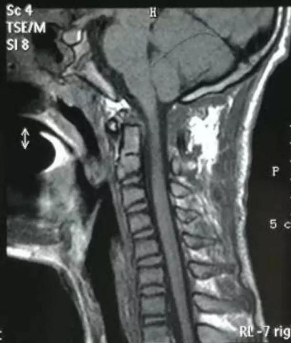寰枢椎脱位手术适应症,寰枢椎脱位手术最广泛麻醉方法